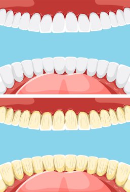 Diş sağlığı ve plaket oluşumunu gösteren illüstrasyon
