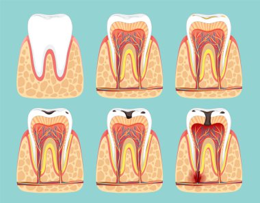 Diş çürüğünün ilerleyişini gösteren resimler.