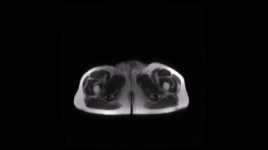 Axial MRI slice of the pelvis and lower abdomen showing surrounding muscles and vertebrae, suitable for anatomy or diagnostic imaging contexts. Grayscale medical scan for clinical reference