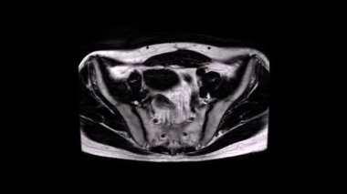 Pelvic MRI cross-section highlighting muscles, bones and surrounding soft tissues in a single axial slice. Useful for medical education, anatomy study
