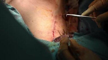 Cerrahi bir bölgenin detaylı bir yakın çekiminde, operasyonla aktif olarak ilgilenen tıbbi personelin yanı sıra dikişler de görülüyor.