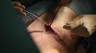 Cerrahlar kendi alanlarında hassas ve gelişmiş uzmanlık göstererek karmaşık bir prosedür uyguluyorlar.