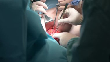 Karmaşık bir cerrahi prosedüre yakın çekim nitelikli profesyoneller tarafından kullanılan karmaşık teknikleri vurgular.