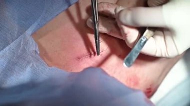Yetenekli bir cerrah, hastanın deri yüzeyi üzerinde çeşitli aletlerle detaylı bir tıbbi prosedür uygular.