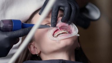 Diş tedavisi. Diş kliniğinde profesyonel diş temizliği. Yüksek kalite 4k görüntü