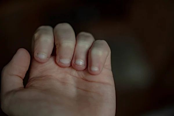 bitten nails hand fingers healthy beauty body