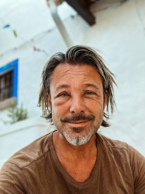 Bronz tenli, sarı saçlı ve sakallı bir adamın şişmiş derisi. Eşek arısı sokmasına karşı alerjik reaksiyon.