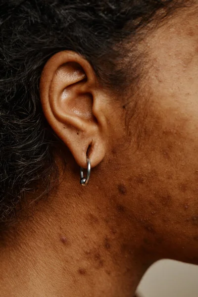 Macro Shot Ethnic Young Woman Ear Piercing Real Skin Texture — Stock Photo, Image