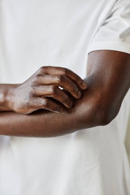 Kolları kaşınan Afrikalı bir Amerikalı 'nın dikey yakın çekimi. Endişeden muzdarip.