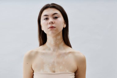 Vitiligo 'lu güzel esmer kadının göğüs portresi. Beyaz arka plana karşı çıplak omuzlarıyla poz veriyor. Stüdyoda eşsiz beyaz lekelerin güzelliğini kucaklıyor.