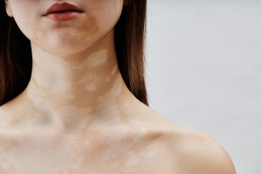 Beyaz vitiligo bantları olan genç bir kadının boynuna ve omuzlarına yakın dur. Stüdyoda güven içinde poz ver. Tarafsız arka planda eşsiz bir cildin doğal güzelliğini kucakla.