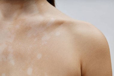 Vitiligo 'lu genç bir kadının köprücük kemiğine yakın çekim. Stüdyoda benzersiz bir şekilde doğal cilt yamalarını kutluyorlar.
