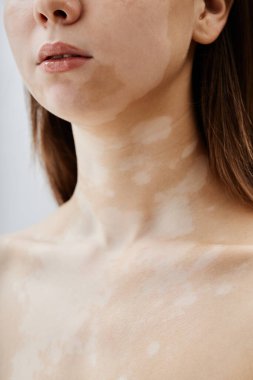 Dudaklara dikey yakın çekim ve boynunda vitiligo bantları olan genç bir kadının çıplak köprücük kemikleri stüdyoda kendine güvenerek poz veriyor eşsiz bir cildin doğal güzelliğini kucaklıyor, boşluğu kopyalıyor.