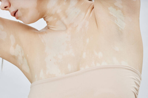 Студия обрезанный снимок молодой женщины с витилиго позируя с поднятыми руками, демонстрируя естественную красоту уникального рисунка на коже в блаженном чувстве самопринятия изолированы на белом