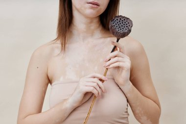 Vitiligo 'lu genç bir kadının kurumuş nilüfer çiçeğini tutarken stüdyoda bej duvara karşı çıplak bir şekilde poz verirken doğal cilt güzelliğini kucaklarken görüntüsü.