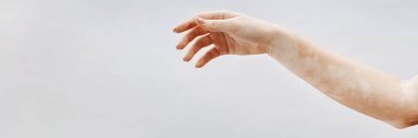 Stüdyoda beyaz arkaplan karşısında vitiligo yamalı kadın kolunun internet sitesindeki resmi, boşluğu kopyala