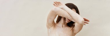 Vitiligo yüzlü genç bir kadının, stüdyoda bej arka planda yakalanan kişisel bilinç duygusuyla yüzünü kapladığı bir web sitesi fotoğrafı, kopyalama alanı