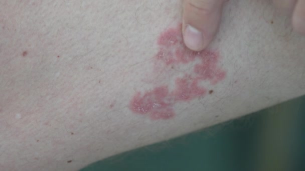 特写镜头的男人摸他腿上的红疹过敏和皮肤病 — 图库视频影像