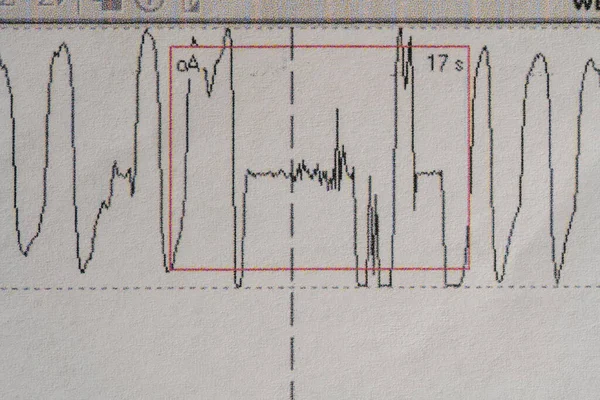 Images charts scientific cardiograms of cardiorespiratory sleep monitoring. Heart pulse or Heart wave, graph on paper. Medical examination cardiogram, close up