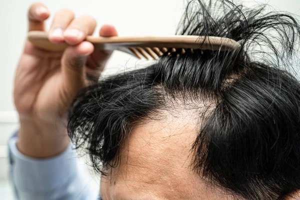 Bald Middle Head Begin Loss Hair Glabrous Mature Asian Business — Photo