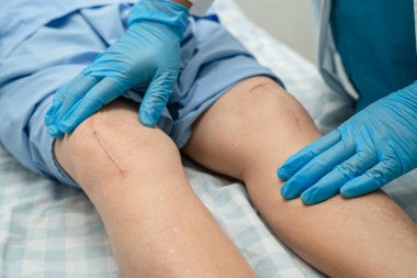 Asyalı yaşlı ya da yaşlı kadın hasta yaralarını gösteriyor. Diz eklemi ameliyatıyla değiştirilmiş. Hemşirelik hastanesi koğuşunda yatağında eklem iltihabı var..