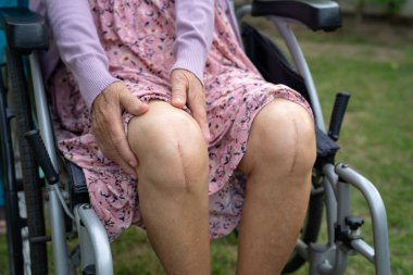 Asyalı yaşlı ya da yaşlı kadın hasta yaralarını gösteriyor. Diz eklemi ameliyatıyla değiştirilmiş. Hemşirelik hastanesi koğuşunda yatağında eklem iltihabı var..