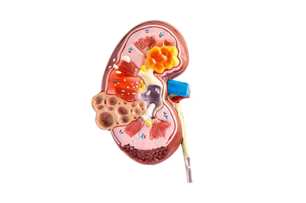 Kidney Disease Chronic Kidney Disease Ckd Model Study Isolated White — Stock Photo, Image