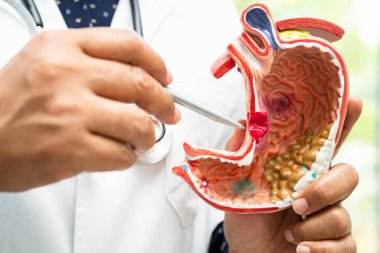 Mide hastalığı, hastanede teşhis ve tedavi için anatomi modeli tutan bir doktor..