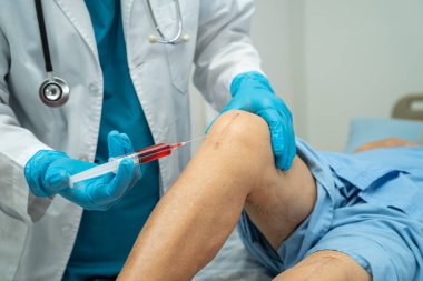 Asyalı yaşlı kadın hasta yaralarını gösteriyor. Diz eklemi, eklem protezi, hastanede ameliyat, güçlü tıbbi konsept..