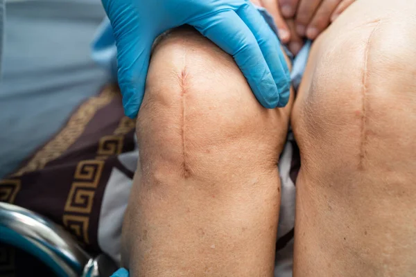 Asiática Anciana Paciente Mostrar Sus Cicatrices Cirugía Total Rodilla Reemplazo — Foto de Stock