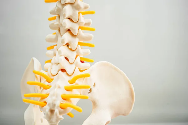 Lendenwirbelsäule Verdrängte Bandscheibenvorfall Spinalnerv Und Knochen Modell Für Die Behandlung — Stockfoto
