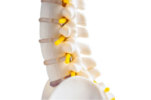 Lendenwirbelsäule Verdrängte Bandscheibenvorfall Spinalnerv Und Knochen Modell Für Die Behandlung — Stockfoto