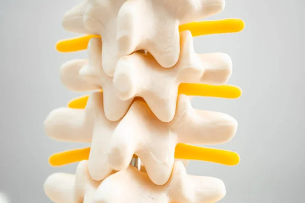 Lumbar Spine Displaced Herniated Disc Fragment Spinal Nerve Bone Model — Stock Photo, Image