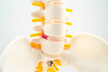 Bel omurgası yerinden oynamış disk parçası, omurilik ve kemik. Ortopedi bölümünde tedavi için model.