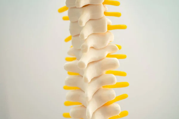 Lumbar spine displaced herniated disc fragment, spinal nerve and bone. Model for treatment medical in the orthopedic department.