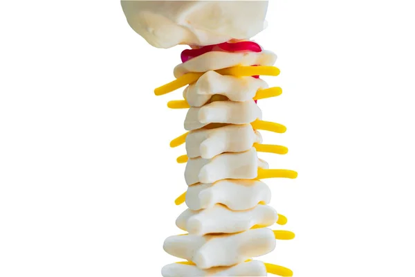 Lendenwirbelsäule Verdrängte Bandscheibenvorfall Spinalnerv Und Knochen Modell Auf Weißem Hintergrund — Stockfoto