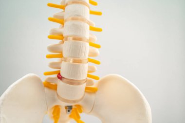 Bel omurgası yerinden oynamış disk parçası, omurilik ve kemik. Ortopedi bölümünde tedavi için model.