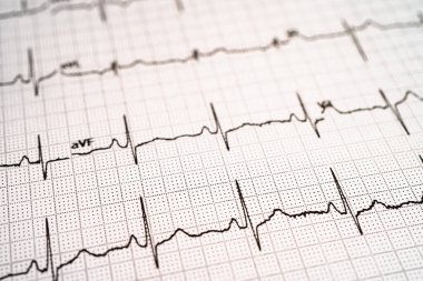Elektrokardiyogram EKG, kalp dalgası, kalp krizi, kardiyogram raporu.