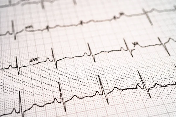 Elektrokardiyogram EKG, kalp dalgası, kalp krizi, kardiyogram raporu.