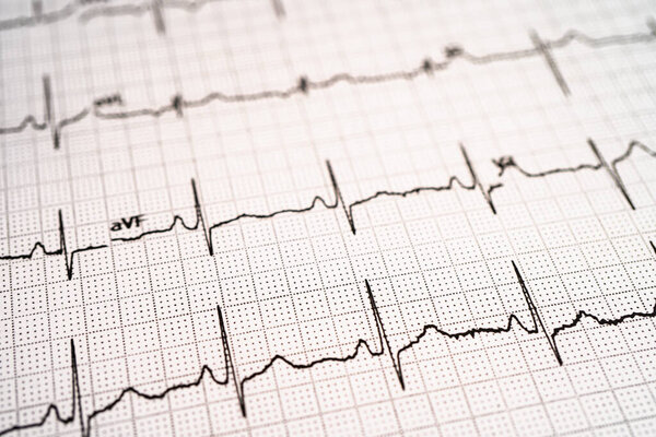 Electrocardiogram ECG, heart wave, heart attack, cardiogram report.