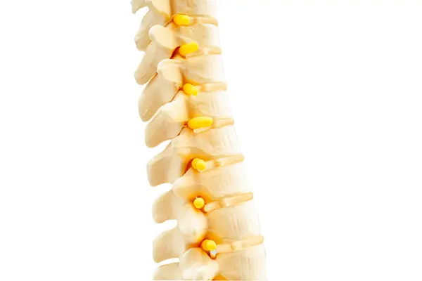 Lumbar Spine Displaced Herniated Disc Fragment Spinal Nerve Bone Model — Stock Photo, Image