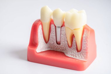 Diş implantı, çeneye yapay diş kökleri, diş tedavisinin kök kanalı, diş eti hastalığı, diş hekimliği üzerine çalışan dişçi modeli.
