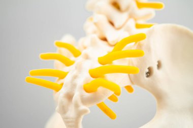 Bel omurgası yerinden oynamış disk parçası, omurilik ve kemik. Ortopedi bölümünde tedavi için model.