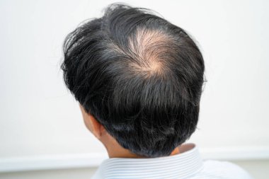 Bald in the middle head and begin no loss hair glabrous of mature Asian business smart active office man.