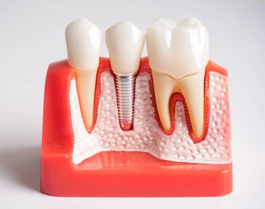 Diş implantı, çeneye yapay diş kökleri, diş tedavisinin kök kanalı, diş eti hastalığı, diş hekimliği üzerine çalışan dişçi modeli.