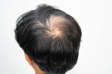 Bald in the middle head and begin no loss hair glabrous of mature Asian business smart active office man.