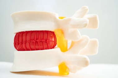 Bel omurgası yerinden oynamış disk parçası, omurilik ve kemik. Ortopedi bölümünde tedavi için model.