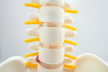 Bel omurgası yerinden oynamış disk parçası, omurilik ve kemik. Ortopedi bölümünde tedavi için model.