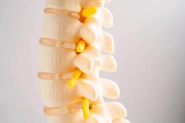 Lendenwirbelsäule Verdrängte Bandscheibenvorfall Spinalnerv Und Knochen Modell Für Die Behandlung lizenzfreie Stockbilder