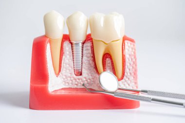 Diş implantı, çeneye yapay diş kökleri, diş tedavisinin kök kanalı, diş eti hastalığı, diş hekimliği üzerine çalışan dişçi modeli.